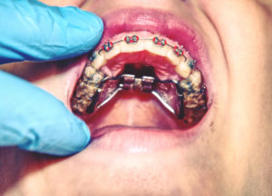 Palatal Expander | Yakima Orthodontics