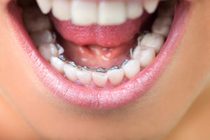 Lingual (Behind Teeth) Braces | Yakima Orthodontics