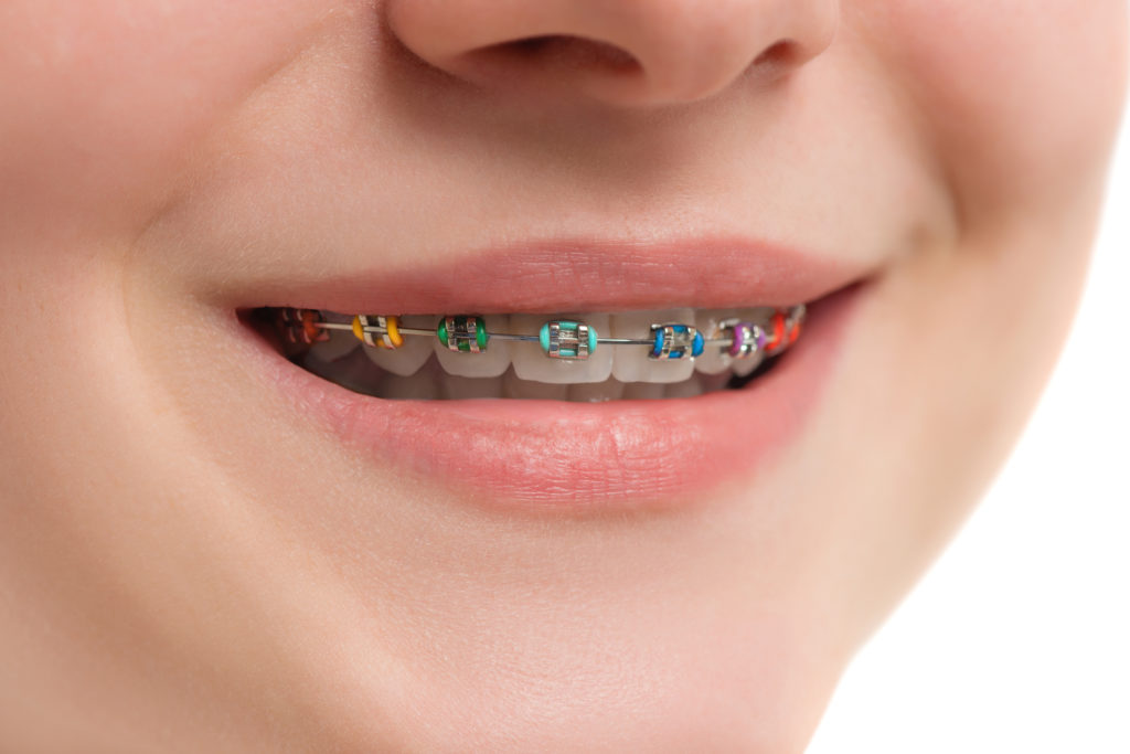 Metal Braces | Yakima Orthodontics